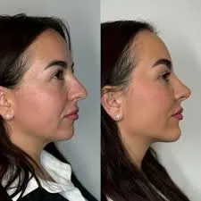 Mentoplastia: estructura, equilibrio facial y valor clínico en la estética avanzada
